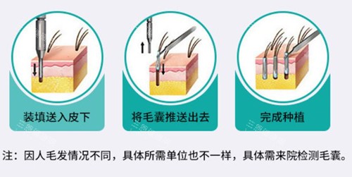 植發(fā)過程示意圖片