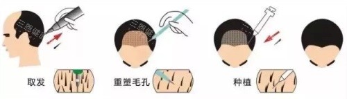 植發(fā)過程圖