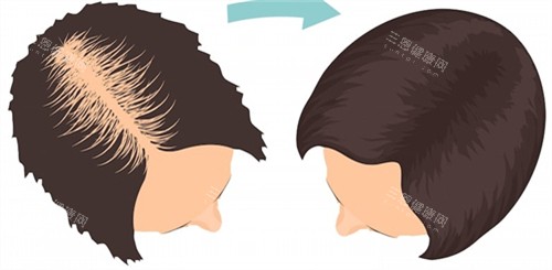 毛發(fā)種植前后對比
