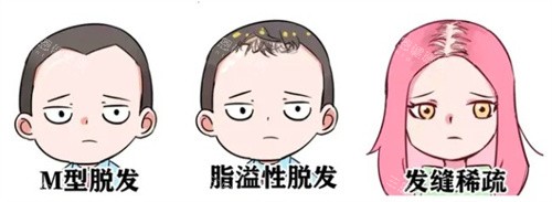 脫發(fā)種類