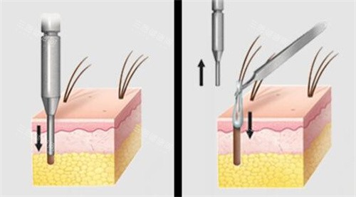 提取毛囊動畫演示圖圖