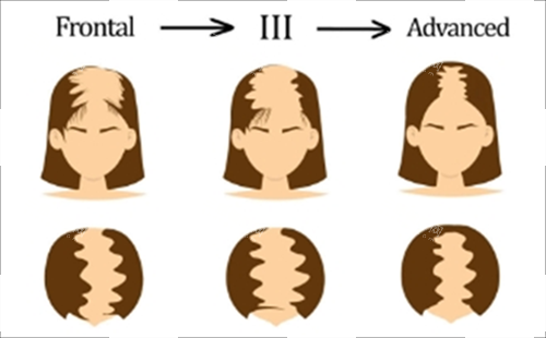 重度脫發(fā)素材