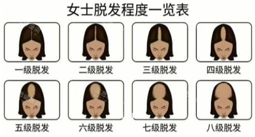 脫發(fā)等級(jí)
