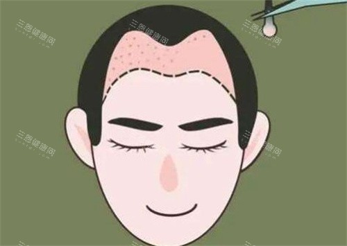 M型發(fā)際線種植