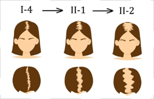 中度脫發(fā)素材