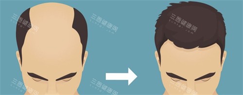 種發(fā)際線前后對(duì)比 種發(fā)際線前后對(duì)比