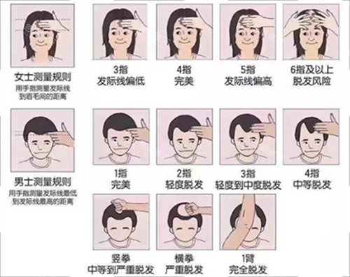 發(fā)際線測(cè)量規(guī)范 發(fā)際線測(cè)量規(guī)范