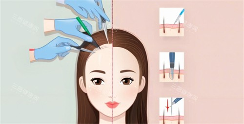 發(fā)際線 發(fā)際線