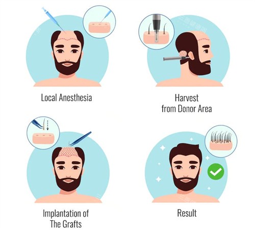 植發(fā)手術過程圖一覽