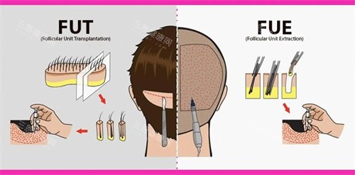 兩種植發(fā)手術對比圖