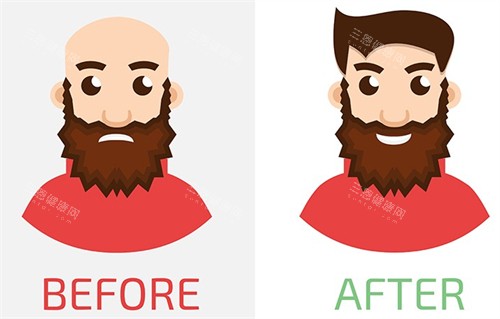 植發(fā)手術對比圖