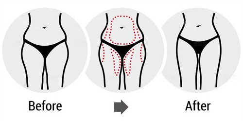 腰腹大腿吸脂前后對比圖