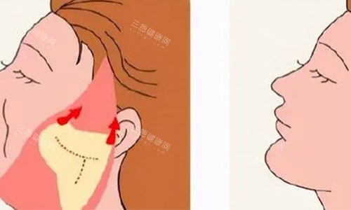 拉皮手術(shù)的術(shù)后對比圖