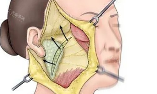 拉皮手術(shù)剖開動畫示意圖