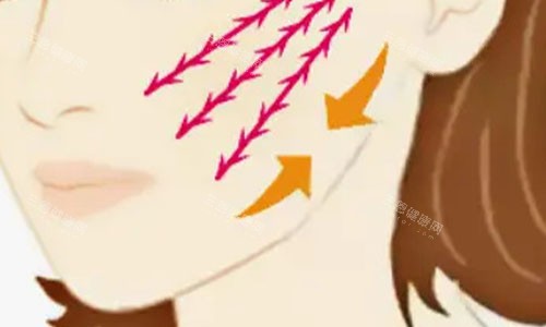 拉皮手術(shù)的大致流程示意圖