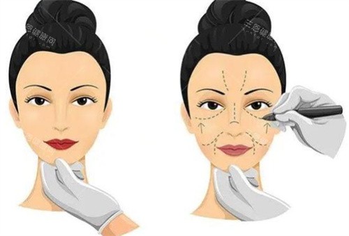 小拉皮手術(shù)過程