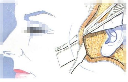 拉皮手術(shù)手術(shù)剖面圖