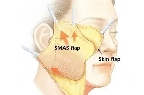 面部拉皮卡通示意圖