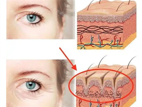眼周筋膜提升前后