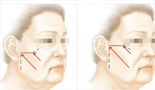 中上面部拉皮提拉方向畫(huà)線(xiàn)圖