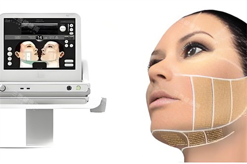 ulthera 超聲提拉