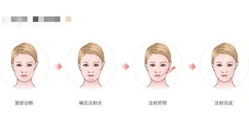 骸肌放松注射過(guò)程示意圖
