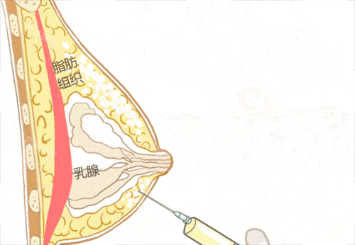 胸部奧美定注射物取出