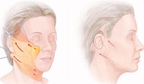 拉皮手術(shù)前后成果對(duì)比展示圖