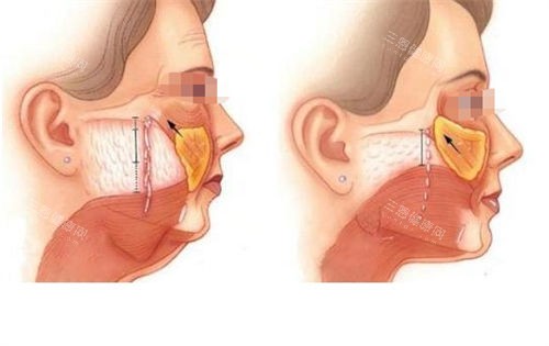 拉皮手術(shù)皮下組織切面對(duì)比展示圖