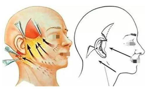 拉皮手術(shù)縫合前后示意圖