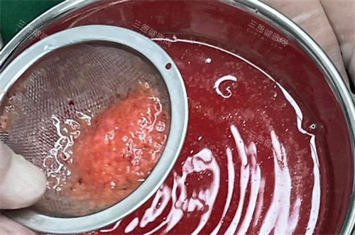 手術(shù)取出的不明注射物