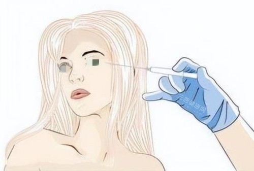 注射膠原蛋白去淚溝示意圖