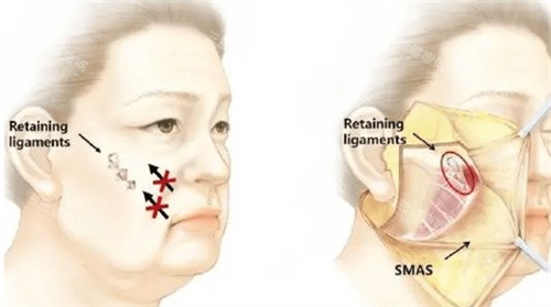 筋膜懸吊怎么做的