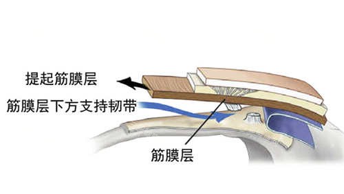SMAS筋膜層圖片展示