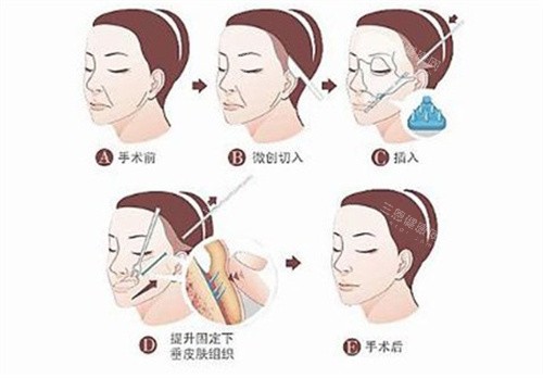 筋膜懸吊手術(shù)過(guò)程