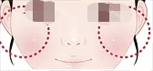 玻尿酸填充眼下填充