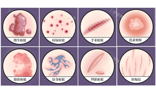 疤痕的種類展示