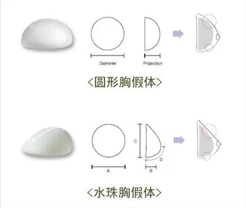 豐胸手術(shù)曼托圓形及水滴形假體植入示意圖