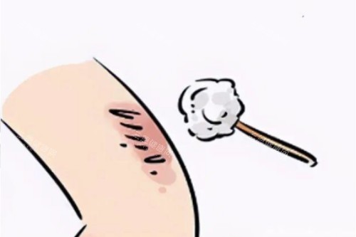 皮膚疤痕卡通圖片展示 皮膚疤痕卡通圖片展示