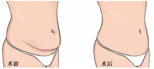 美人魚腹壁成形手術(shù)前后的區(qū)別
