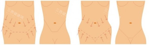 腹壁成形可改善的腰腹?fàn)顟B(tài)