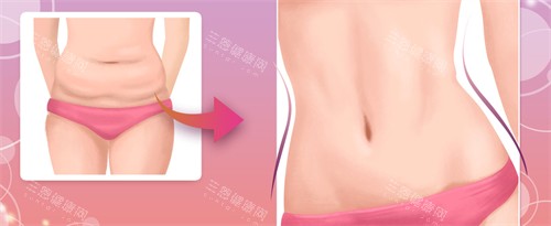 腹壁成形手術(shù)前后對比圖