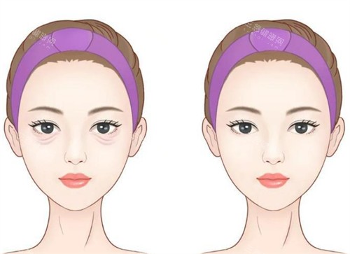 年輕祛眼袋前后對比 年輕祛眼袋前后對比