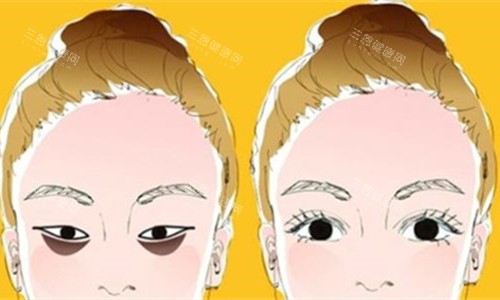 眼袋明顯對比圖 眼袋明顯對比圖