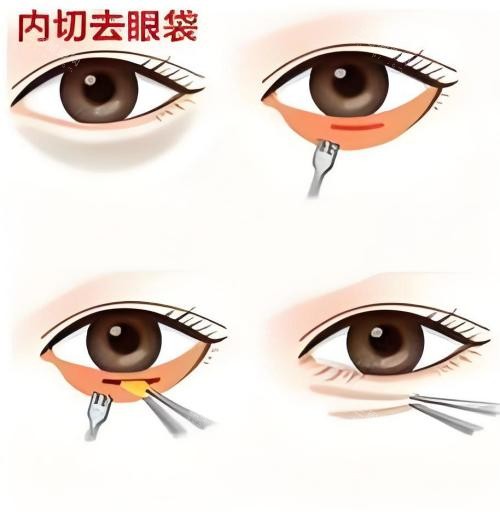 內(nèi)切去眼袋演示動畫圖 內(nèi)切去眼袋演示動畫圖
