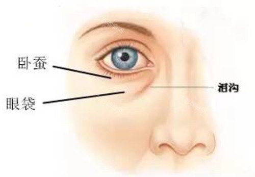 眼下臥蠶淚溝及眼袋對比示意圖 眼下臥蠶淚溝及眼袋對比示意圖
