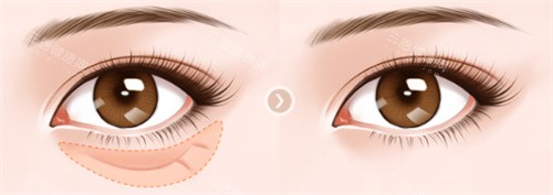 眼袋對比圖 眼袋對比圖