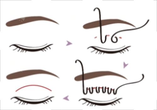 埋線雙眼皮過程圖示