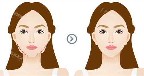 面部提升前后對(duì)比