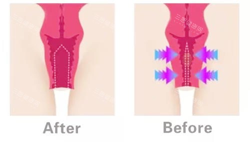 陰道緊縮對比圖